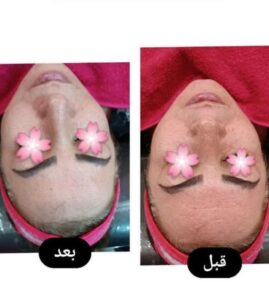 پک کربوکسی تراپی لکسینا Lexina