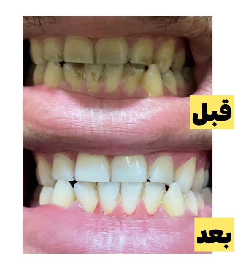 پودر جرمگیر و سفیدکننده دندان اونیس UNNIS